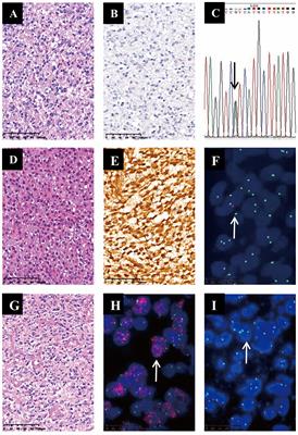 MGMT unmethylation and high levels of CD47 and TIGIT indicate a poor prognosis in adult diffuse gliomas